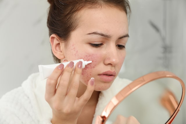 teen girl with acne problem applying cream