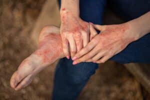 eczema dermatitis on hands and feet