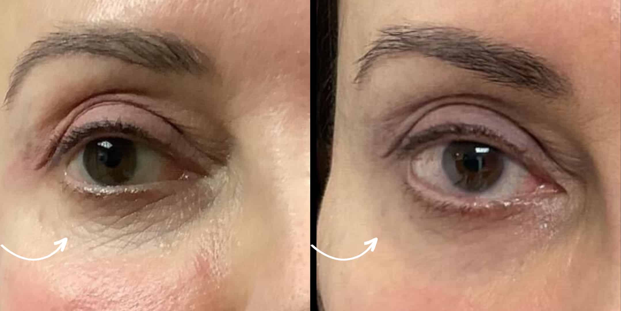 Mprpheus8 Undereye Before after