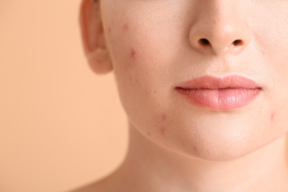 Young,Woman,With,Acne,Problem,On,Color,Background,,Closeup