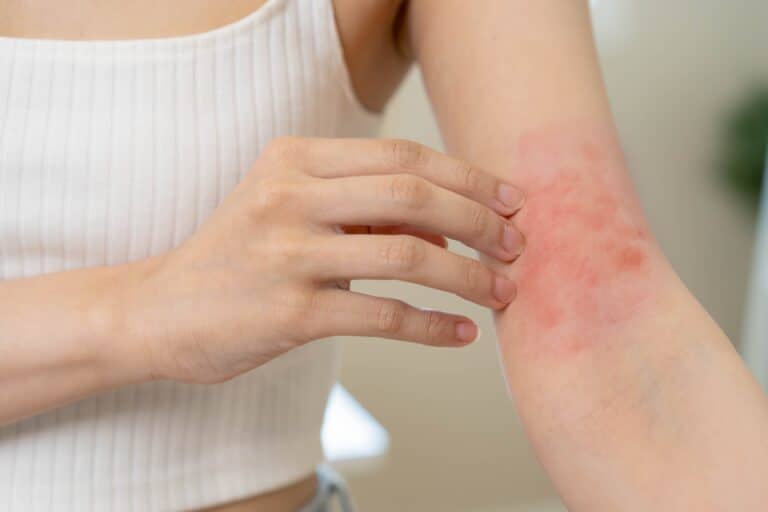 A woman showing an eczema flare-up on her arm