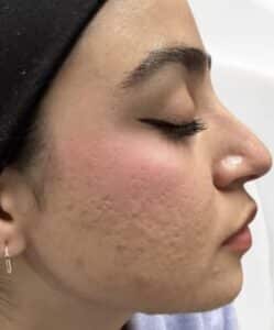 After Image: Acne on Face Side Profile