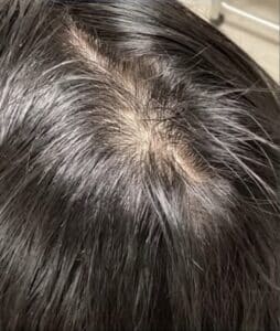 After Image: Hairloss