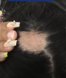 Before Image: Hairloss