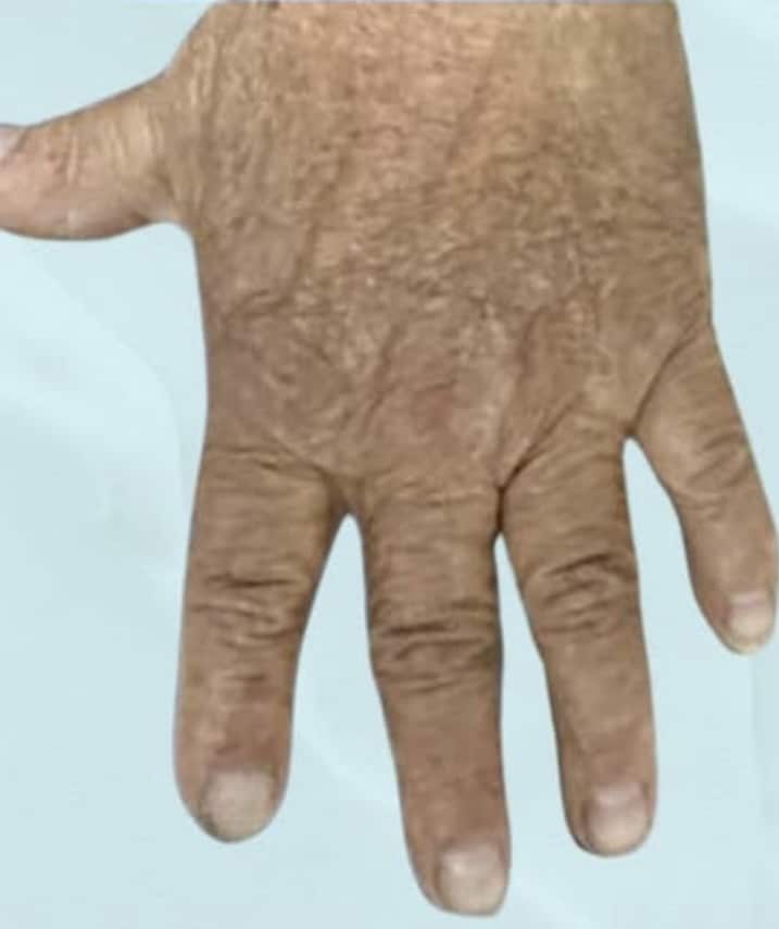 After Image: Psoriasis - other