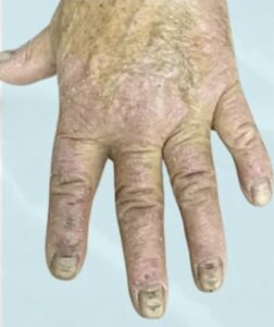 Before Image: Psoriasis