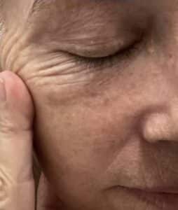 After Image: Seborrheic Keratosis