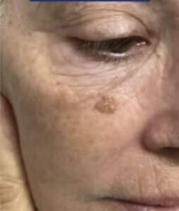 Before Image: Seborrheic Keratosis