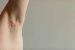 Photo of a man’s armpit with hidradenitis suppurativa breakout