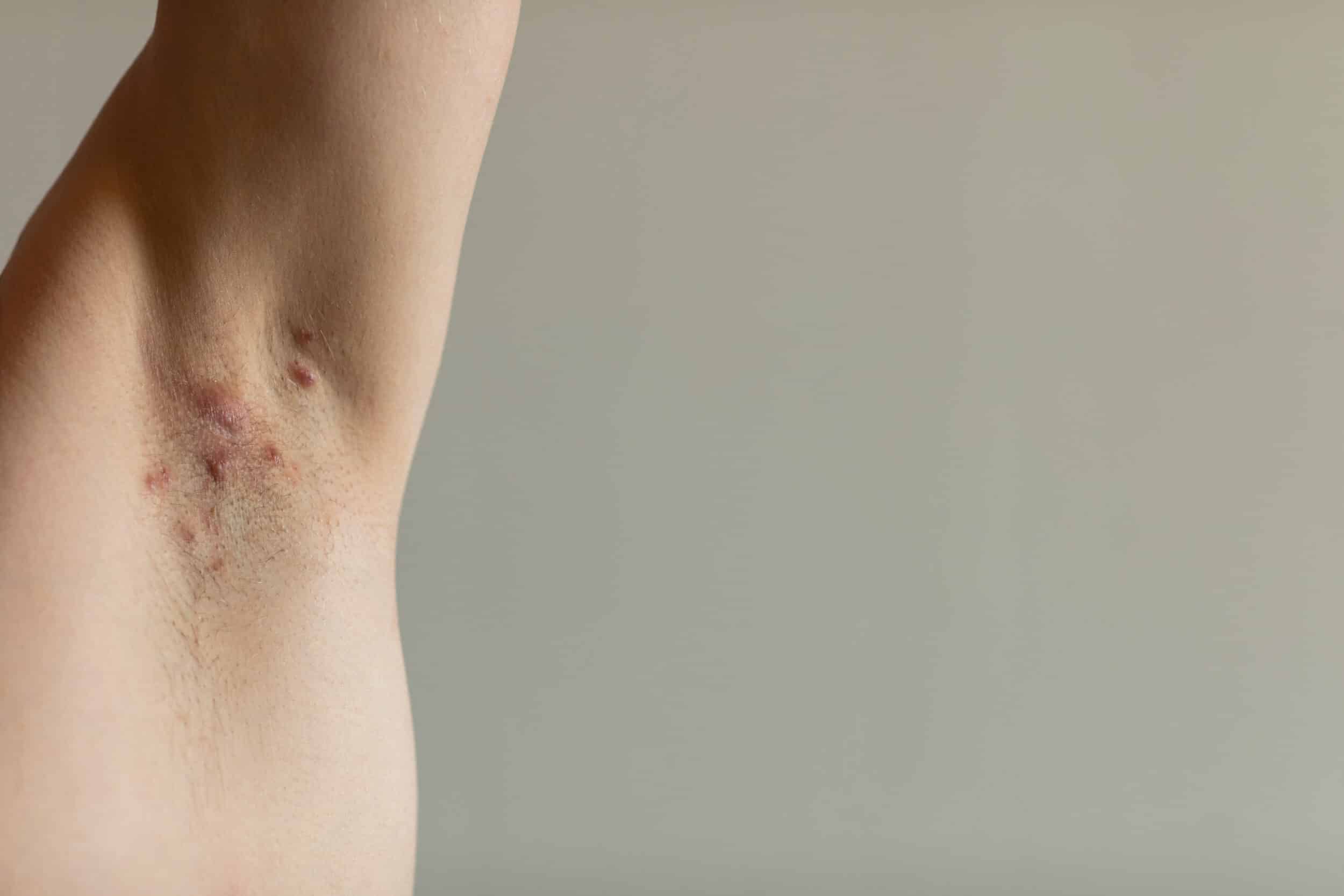 Person with hidradenitis suppurativa flareup breaking out in their armpit